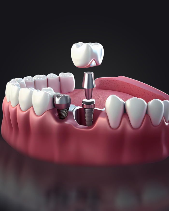 Implant Tedavisi